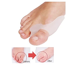 Hallux Valgus, Oignon Pied Hallux Valgus, Oignon Pied